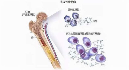 骨髓瘤mp方案指的是什么，多发性骨髓瘤的治疗进展有哪些